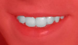 Abbildung 4: Kein Zahnfleischbluten: In der Quick Mask ist das Bild rot eingefärbt